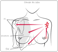 cancer du sein