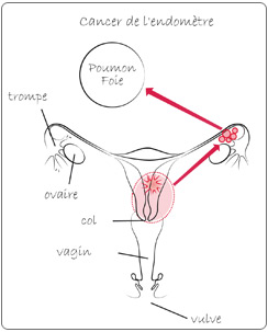 cancer endometre