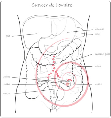 cancer ovaire